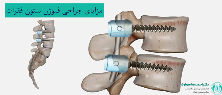 مزایای انجام جراحی فیوژن ستون فقرات مزایای انجام جراحی فیوژن ستون فقرات