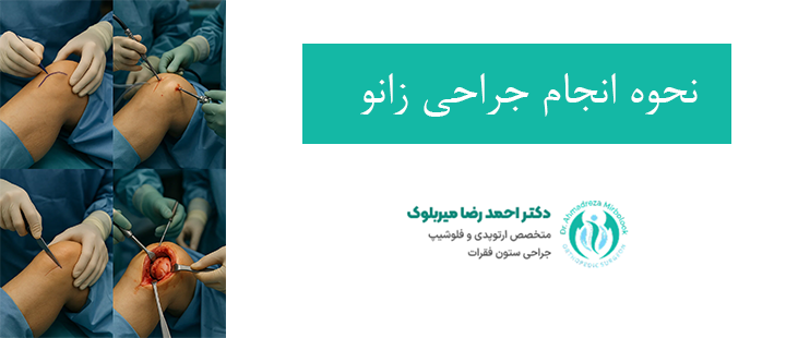 نحوه انجام جراحی زانو نحوه انجام جراحی زانو