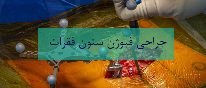 جراحی فیوژن ستون فقرات چیست؟ جراحی فیوژن ستون فقرات چیست؟