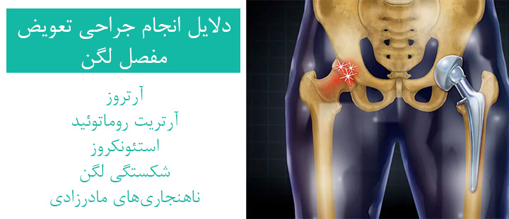 دلایل انجام جراحی تعویض مفصل لگن دلایل انجام جراحی تعویض مفصل لگن