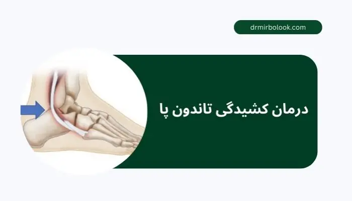 درمان کشیدگی تاندون پا چیست؟