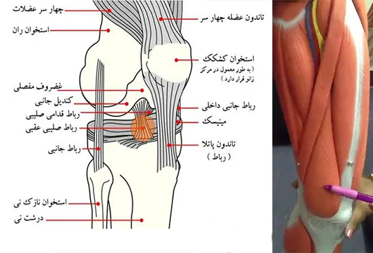 پارگی عضله چهار سر ران
