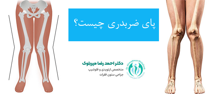 درباره زانوی ضربدری درباره زانوی ضربدری