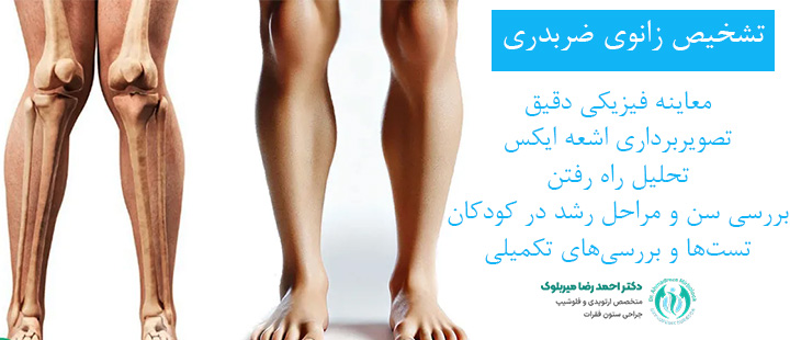 تشخیص زانوی ضربدری تشخیص زانوی ضربدری