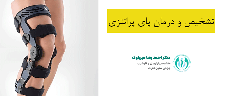 تشخیص و درمان پای پرانتزی تشخیص و درمان پای پرانتزی