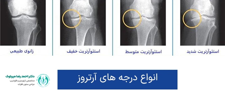 انواع درجه های آرتروز انواع درجه های آرتروز