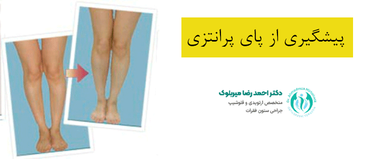 پیشگیری از پای پرانتزی پیشگیری از پای پرانتزی
