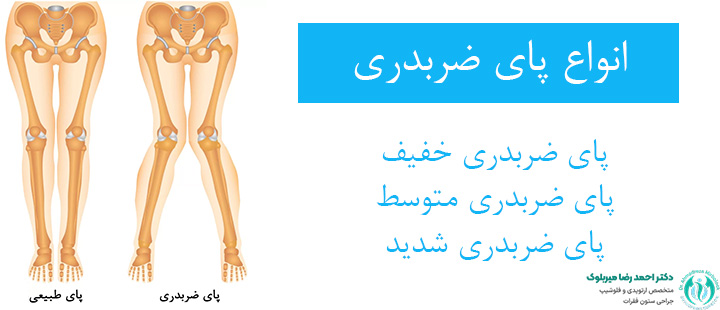 انواع زانوی ضربدری انواع زانوی ضربدری
