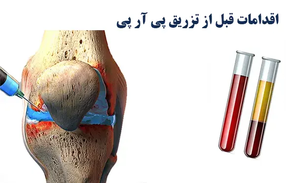 اقدامات قبل از تزریق پی آر پی