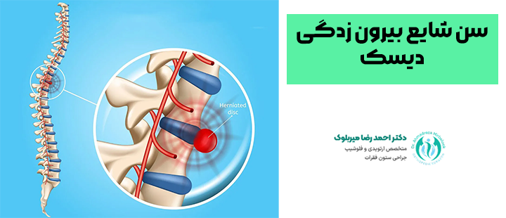 سن شایع بیرون زدگی دیسک