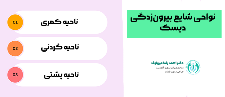 نواحی شایع بیرونزدگی دیسک نواحی شایع بیرونزدگی دیسک