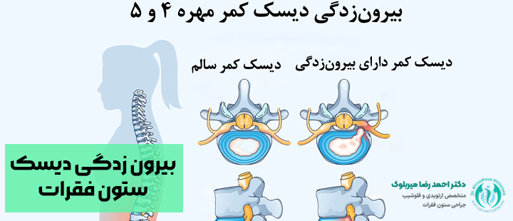 بیرون زدگی دیسک ستون فقرات بیرون زدگی دیسک ستون فقرات