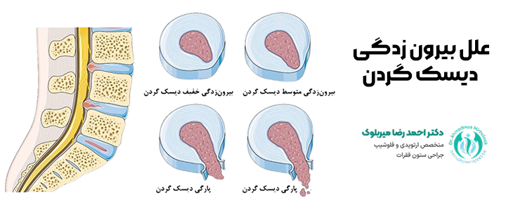 علل بیرون زدگی دیسک گردن