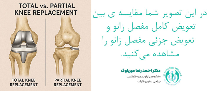 مقایسه تعویض کامل مفصل زانو با تعویض جزئی مفصل زانو مقایسه تعویض کامل مفصل زانو با تعویض جزئی مفصل زانو