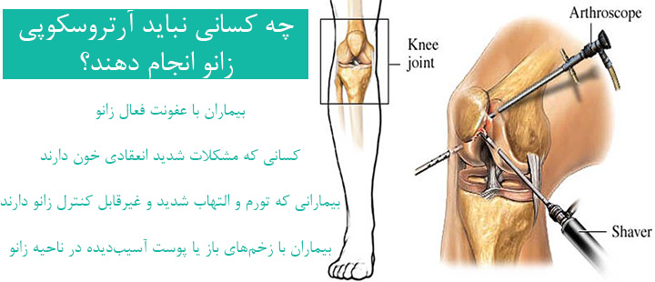 افراد نامناسب برای آرتروسکوپی زانو افراد نامناسب برای آرتروسکوپی زانو