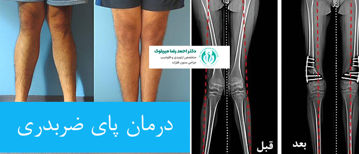 درمان پای ضربدری درمان پای ضربدری
