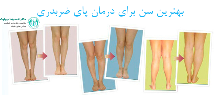 بهترین سن برای درمان پای ضربدری بهترین سن برای درمان پای ضربدری
