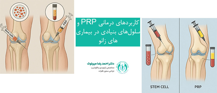 کاربردهای درمانی PRP و سلولهای بنیادی در بیماریهای زانو