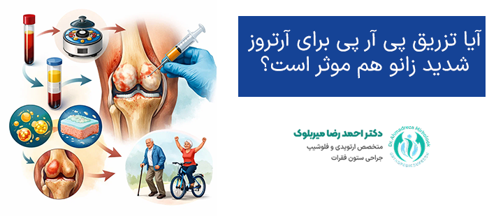 آیا تزریق پی آر پی برای آرتروز شدید زانو هم موثر است؟
