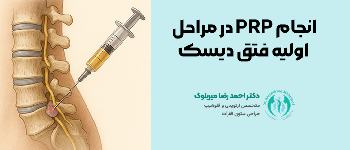 انجام PRP در مراحل اولیه فتق دیسک