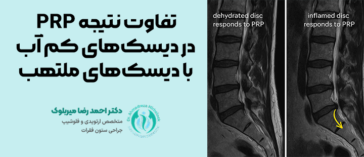 تفاوت نتیجه PRP