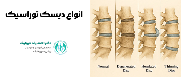 انواع دیسک توراسیک