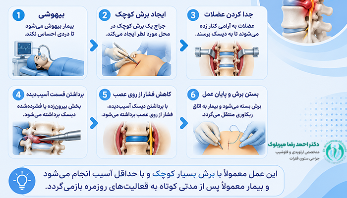 جراحی دیسک کمر چگونه انجام می شود؟