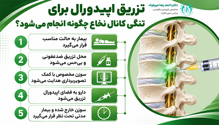 نحوه تزریق اپیدورال برای تنگی کانال نخاع