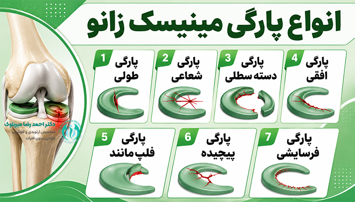 پارگی مینیسک زانو چه انواعی دارد؟