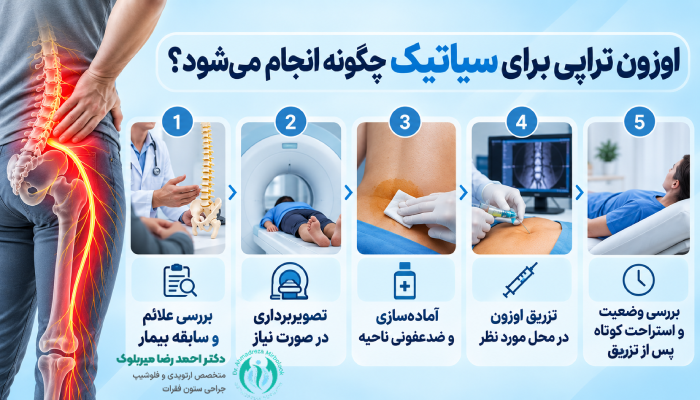 اوزون تراپی برای سیاتیک چگونه انجام میشود؟